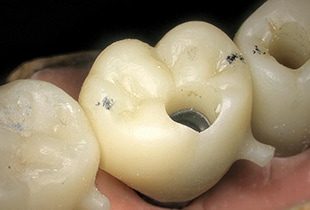 Waarneming van een tandheelkundig implantaat
